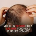 calvitie masculine pourquoi
