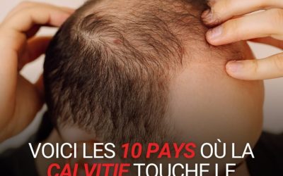 Calvitie masculine : pourquoi privilégier une prothèse capillaire en cheveux naturels ?