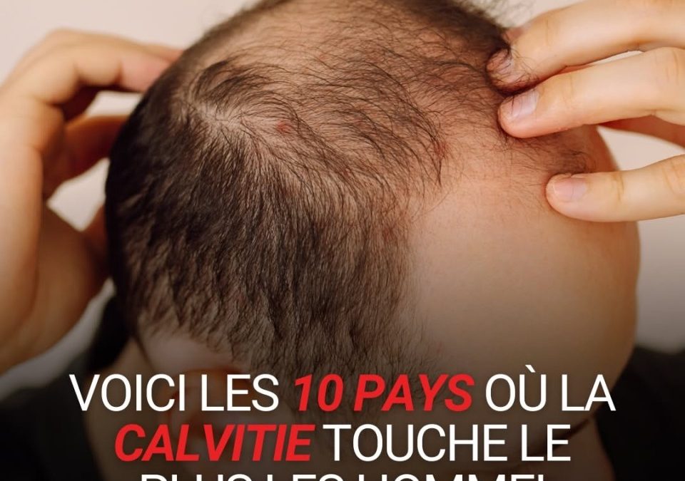 Calvitie masculine : pourquoi privilégier une prothèse capillaire en cheveux naturels ?