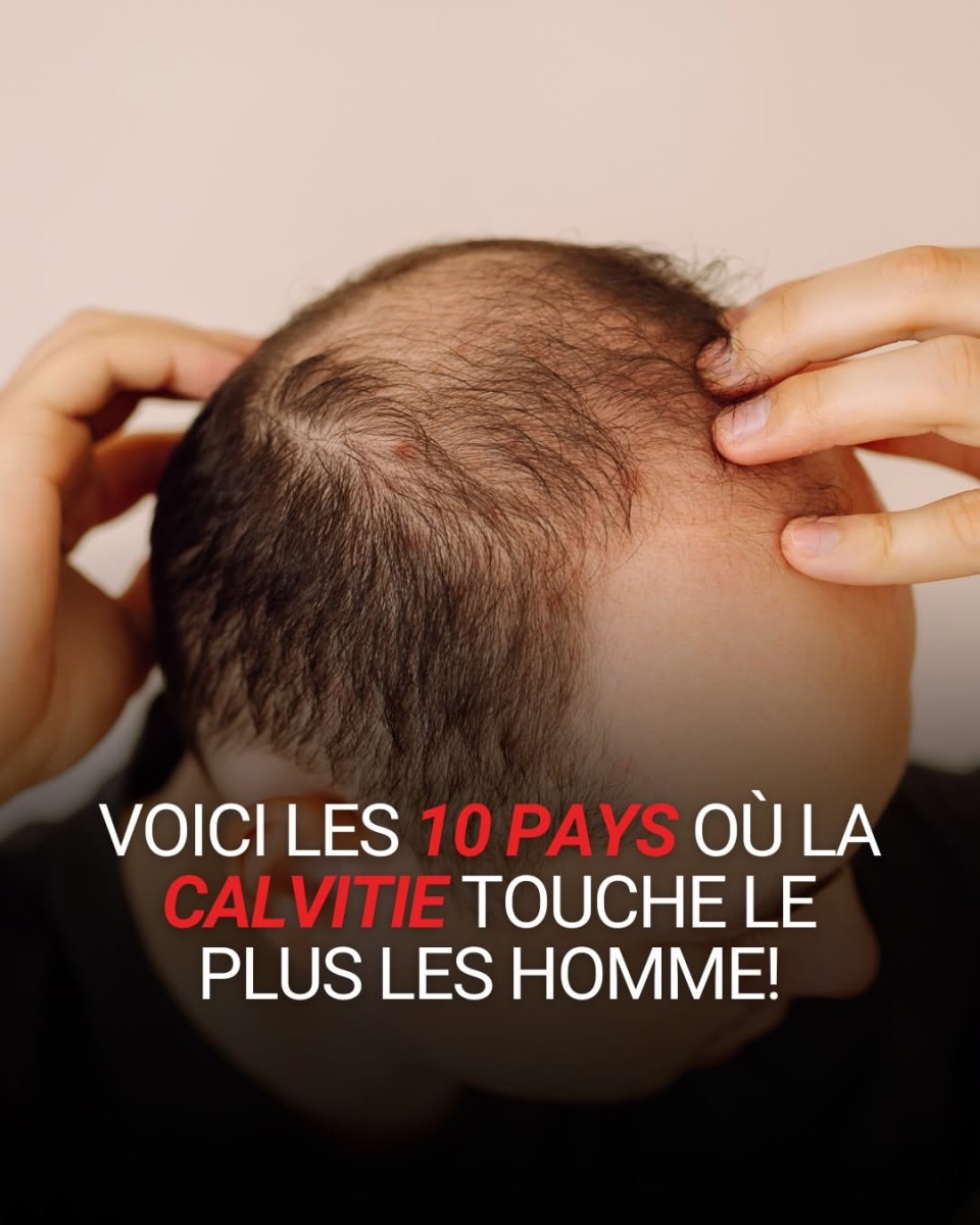 calvitie masculine pourquoi
