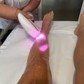 epilation definitive laser