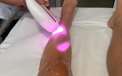 Épilation définitive au laser : guide et conseils pour faire le bon choix