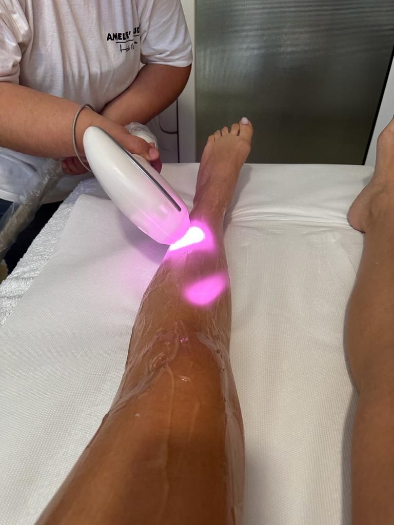 epilation definitive laser