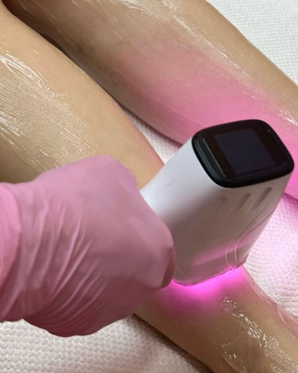 epilation definitive